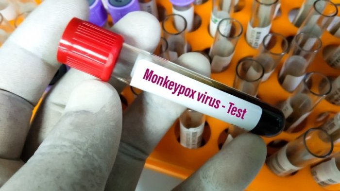    Rusiyada  ilk meymunçiçəyi xəstəliyi  qeydə alınıb   