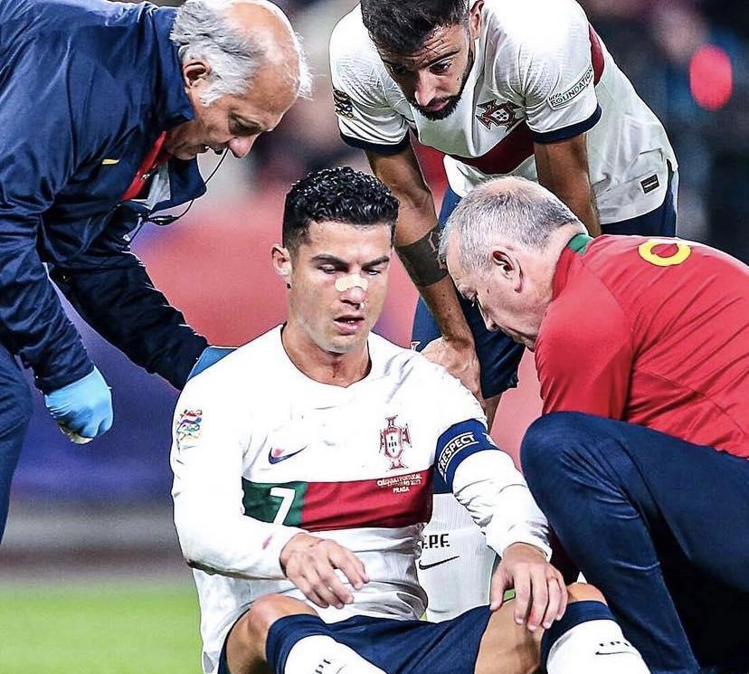Rəqib qapıçı Ronaldonun burnunu əzdi -    FOTOLAR   
