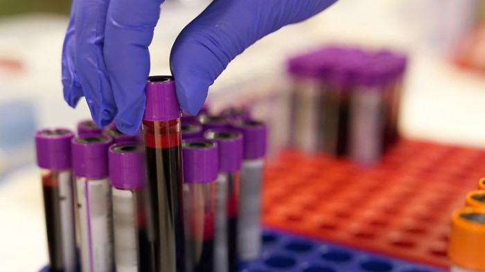   Bluttest könnte 50 Krebsarten nachweisen  