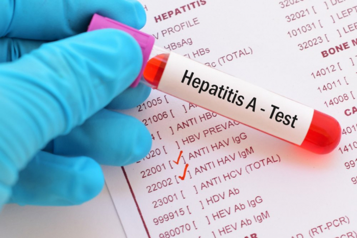  Mingəçevirdə beş uşağa kəskin virus hepatiti diaqnozu qoyulub -  YENİLƏNİB  