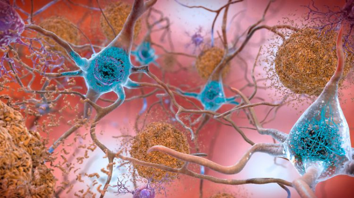   Kann Alzheimer übertragen werden?  