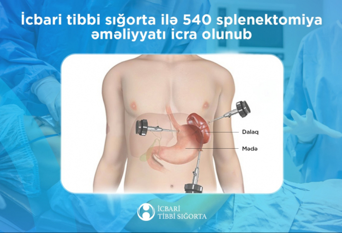 Tibbi sığorta ilə 540 splenektomiya əməliyyatı icra olunub