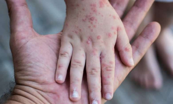     TABIB:   Azerbaiyán no ha registrado casos de mpox  