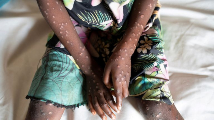 UN agency seeks $18.5M in aid to treat mpox in east, southern Africa