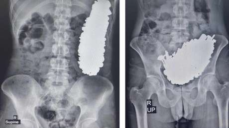 Se queja de dolor abdominal y le extraen 3 kg de metal del estómago