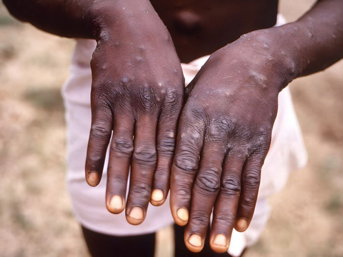 Mpox : 866 décès en Afrique depuis le début de l