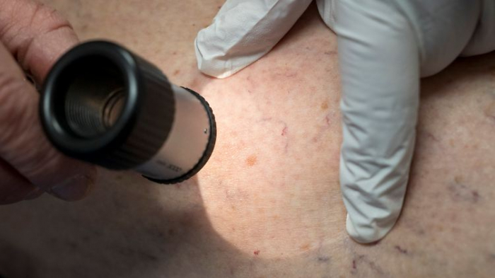  Zahl der Hautkrebsbehandlungen in Kliniken steigt enorm  