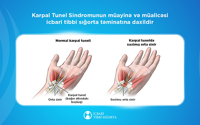 Karpal Tunel Sindromunun müalicəsi tbbi sığorta təminatına daxildir