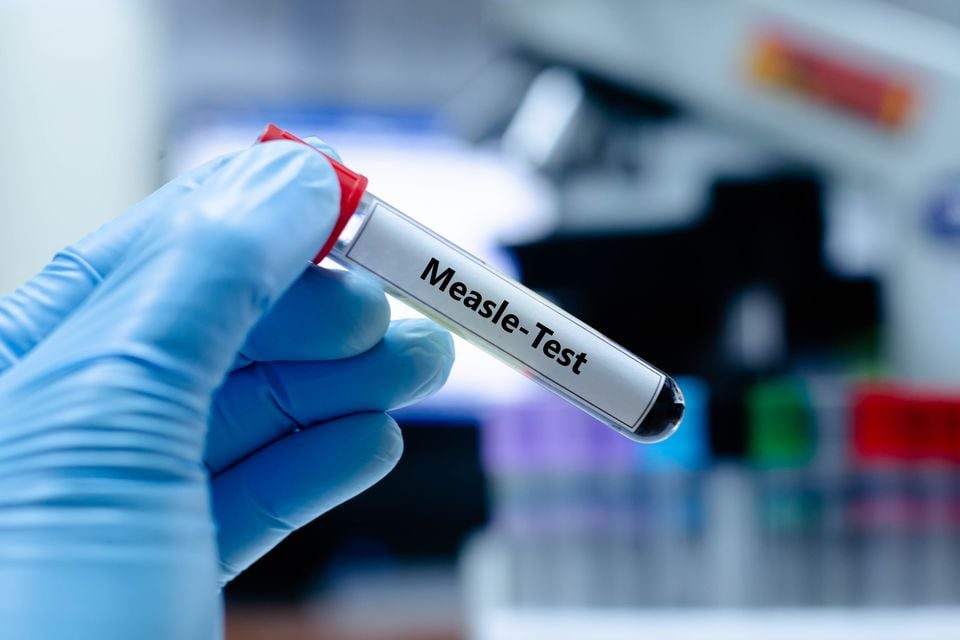 Namibia declares measles outbreak in northwestern region
