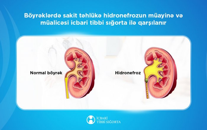 Böyrəklərdə hidronefrozun müalicəsi sığorta ilə qarşılanır