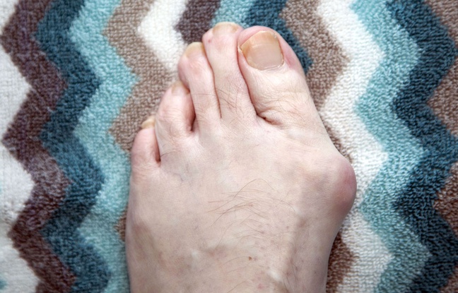 Oignon, pied tordu: Comment soigner un hallux valgus?