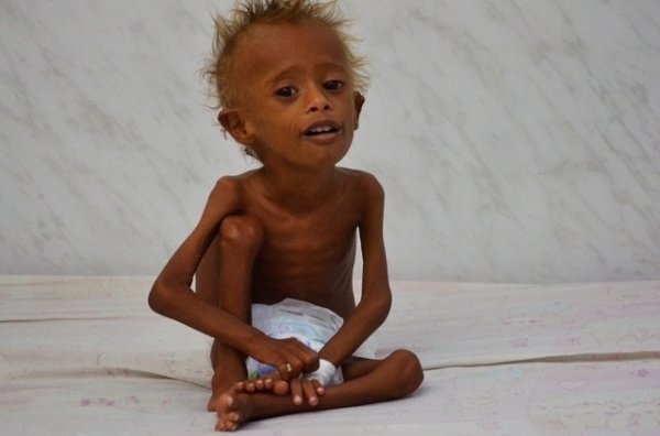 Malnutrition: les chiffres effarants de l`UNICEF