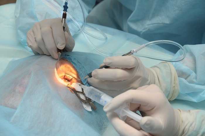 Chirurgie de la cataracte : Des implants de mauvaise qualité marqués CE