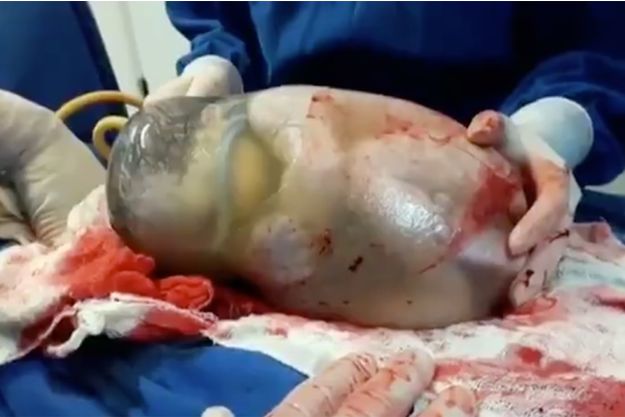 Incroyable naissance d’un bébé recroquevillé dans son sac amniotique - VIDEO