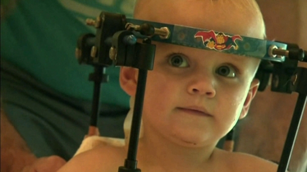 Toddler"s head reattached to spine after car crash - VIDEO