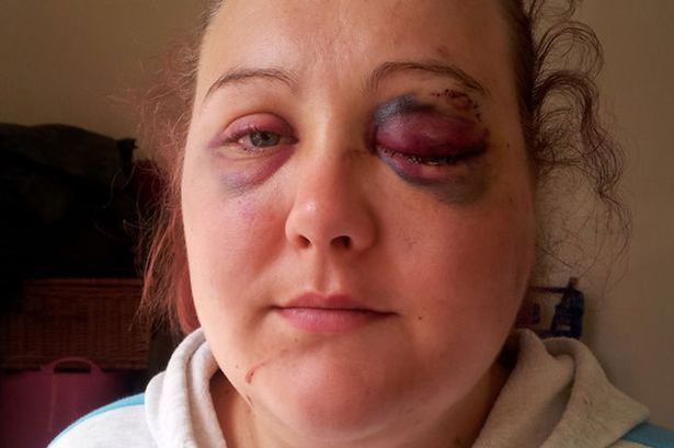 `I will find the stiletto heel attacker who blinded me in one eye` 
