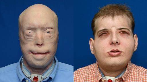 Bisher umfassendste Gesichtstransplantation in den USA