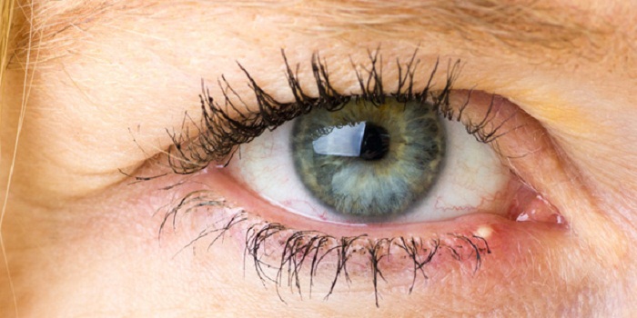 Augenentzündung – das hilft jetzt