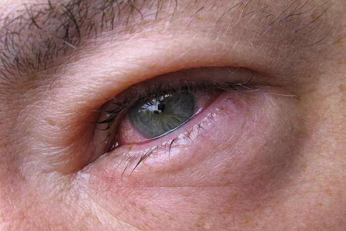 Augengrippe: Symptome und Behandlung