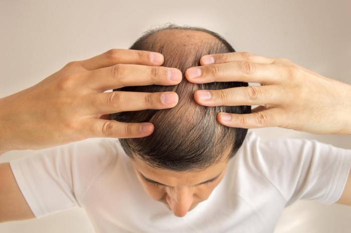 Men going bald or grey at a young age at greater risk of heart disease