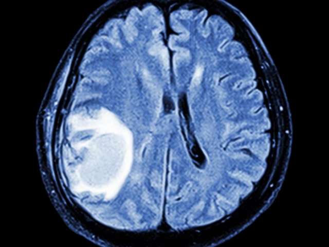 Brain tumours effectively treated by injecting patients with viruses