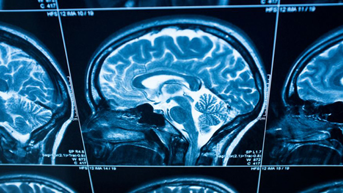 Brain scans could predict patients at risk of major depression