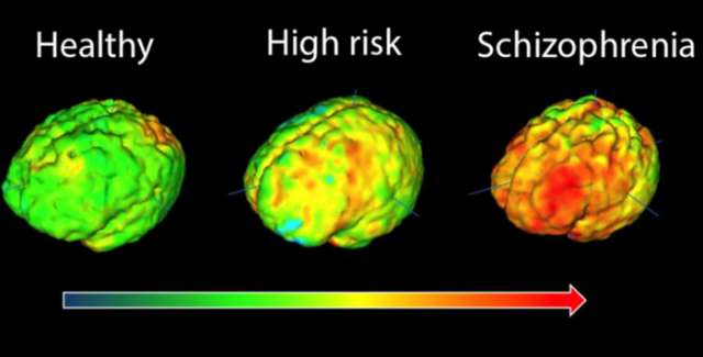 Immune clue to preventing schizophrenia