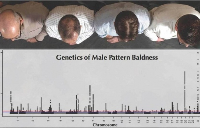 Descubiertos los 287 genes que provocan la calvicie