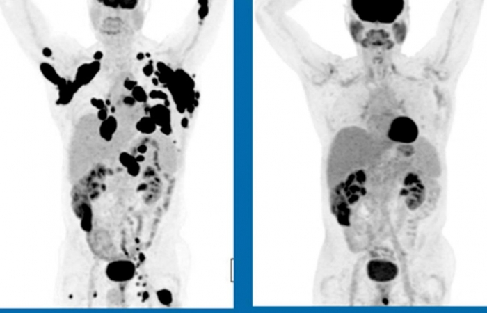 New cancer drug appears to cure a third of terminal cancers