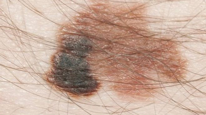 Fast-tracked skin cancer drug pembrolizumab gets approval