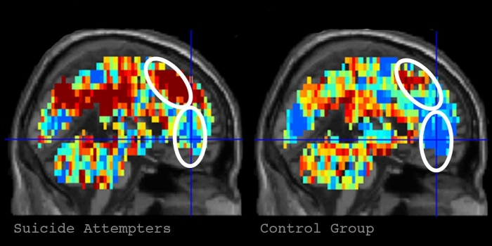 Machine learning reveals what suicidal thoughts look like in brain
Machine learning reveals what suicidal thoughts look like in brain