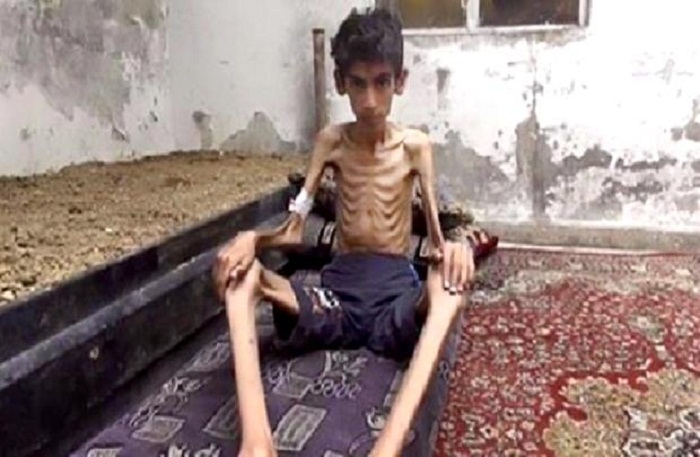 Plus de 20.000 enfants syriens menacés de famine en Syrie