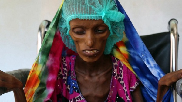 Yémen : Saïda, symbole de la famine qui ravage le pays
