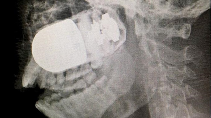Ärzte entfernen scharfe Granate aus Kopf