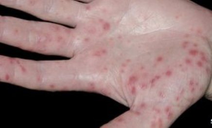 Hand, foot and mouth disease: First vaccine