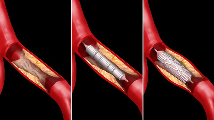 Do heart stents work? What you need to know