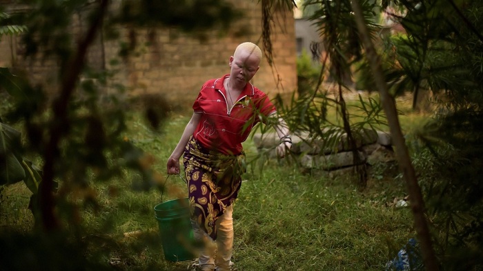 Die Insel der Albinos ist ihre letzte Zuflucht