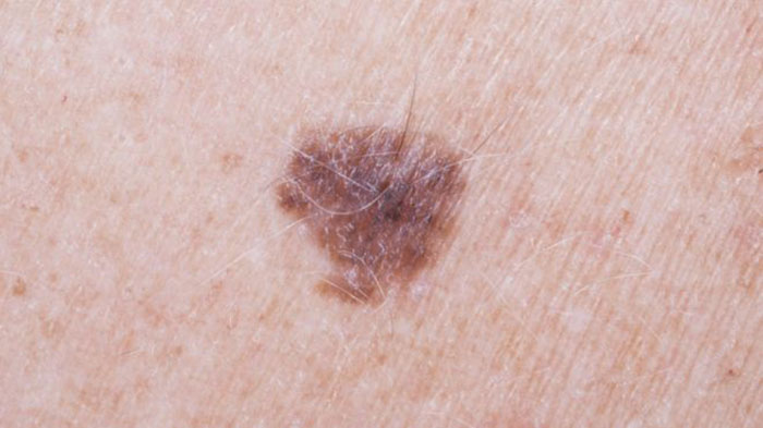 Arm mole count `predicts skin cancer risk`