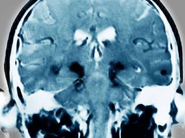 Just one head injury increases Parkinson