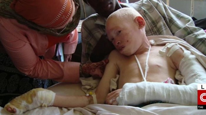 Malawi`s albinos at risk of `total extinction,` U.N. warns