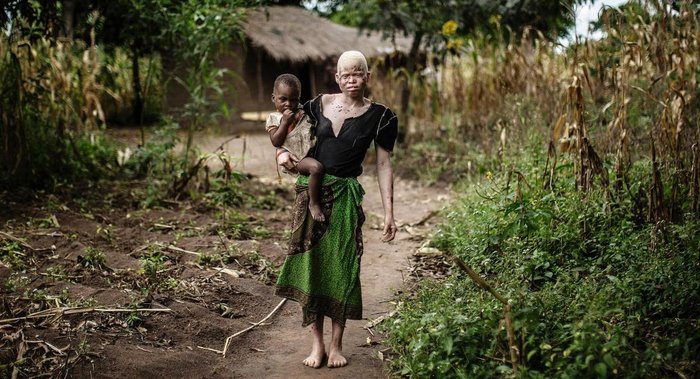 Albino nine-year-old `decapitated` in Malawi