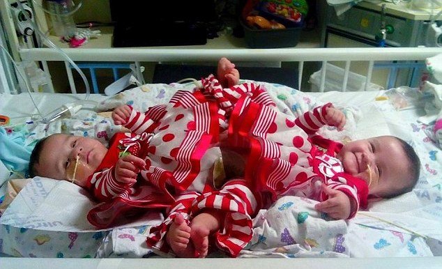 Conjoined Texas twins born as part of set of triplets get set for separation surgery 