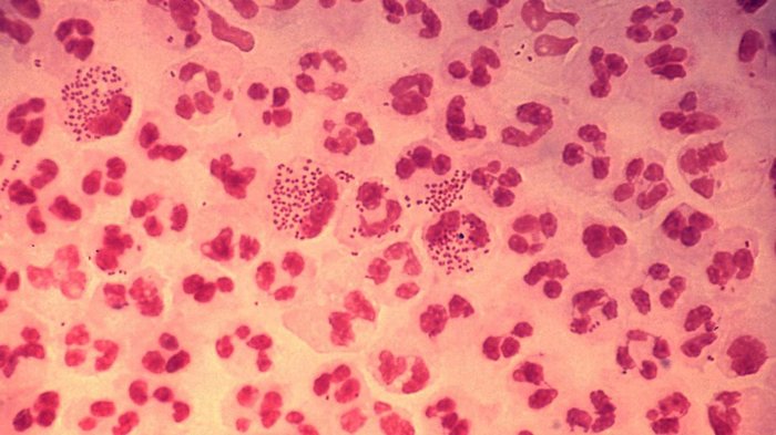 New strain of `super gonorrhea` could be untreatable