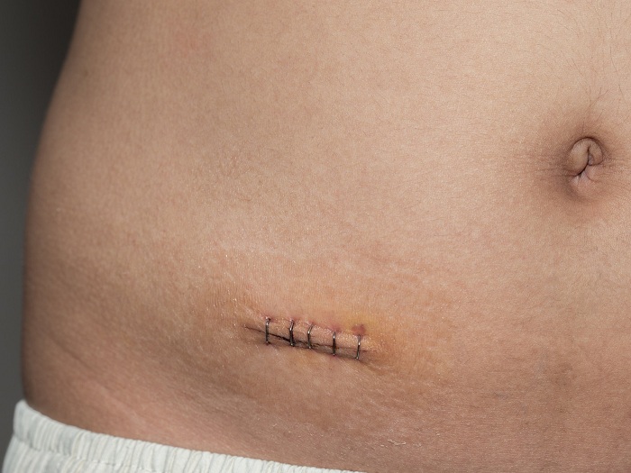 Scientists have figured out how to make wounds heal without scars