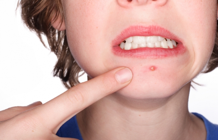 Researchers might have figured out why bacteria only causes acne in some people