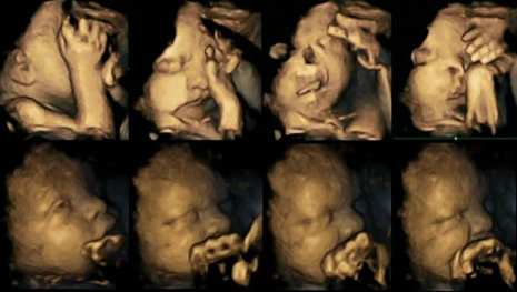 Ultrasounds show fetuses react to mothers` smoking