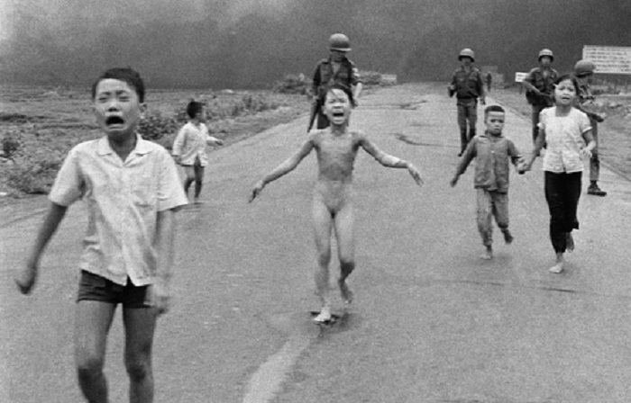 43 ans après, la petite fille vietnamienne brûlée au napalm tente de soigner ses blessures au laser - PHOTOS