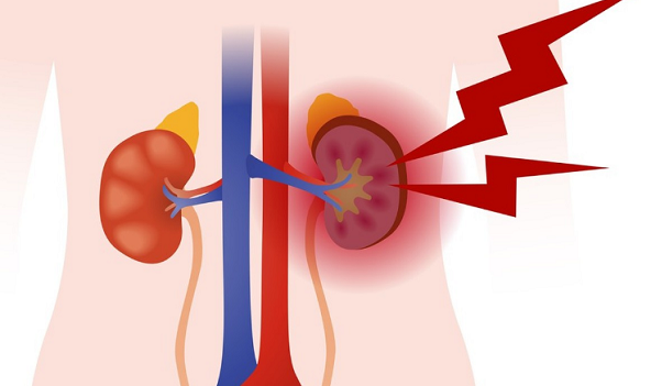 4 choses à faire pour diminuer le risque d’avoir un cancer du rein