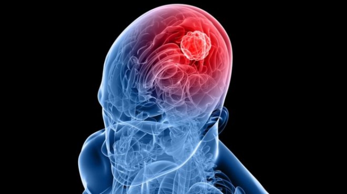 Zika virus used to treat aggressive brain cancer